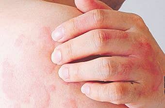 <div class="paragraphs"><p>ಅಲರ್ಜಿ: ಕೆರೆಯಲು ಕರೆಯುವ ಅರ್ಟಿಕೇರಿಯ!</p></div>