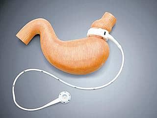 ಬ್ಯಾರಿಯಾಟ್ರಿಕ್ ಚಿಕಿತ್ಸೆಯ ಈ ದಾರಿ