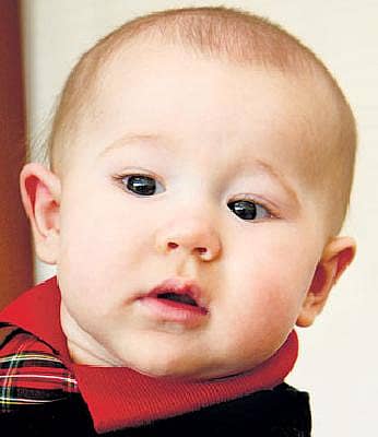 ಮಗುವಿಗೆ ಬೊಕ್ಕ ತಲೆಯೇ?