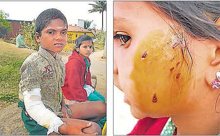 ರಾಮನಗರದ ಕೊತ್ತಿಪುರದಲ್ಲಿ ಹುಚ್ಚುನಾಯಿ ಕಡಿತಕ್ಕೊಳಗಾಗಿರುವ ಬಾಲಕ ರಾಜು (ಎಡಚಿತ್ರ) ಬಾಲಕಿಯ ಕೆನ್ನೆಗೆ ಹುಚ್ಚುನಾಯಿ ಕಡಿದಿರುವುದು