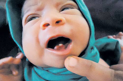 ಯಲ್ಲಾಪುರದ ಸರ್ಕಾರಿ ಆಸ್ಪತ್ರೆಯಲ್ಲಿ ಭಾನುವಾರ ಜನಿಸಿದ ಅವಳಿ ಮಕ್ಕಳ ಬಾಯಲ್ಲಿ ಮೂಡಿರುವ ಹಲ್ಲುಗಳು