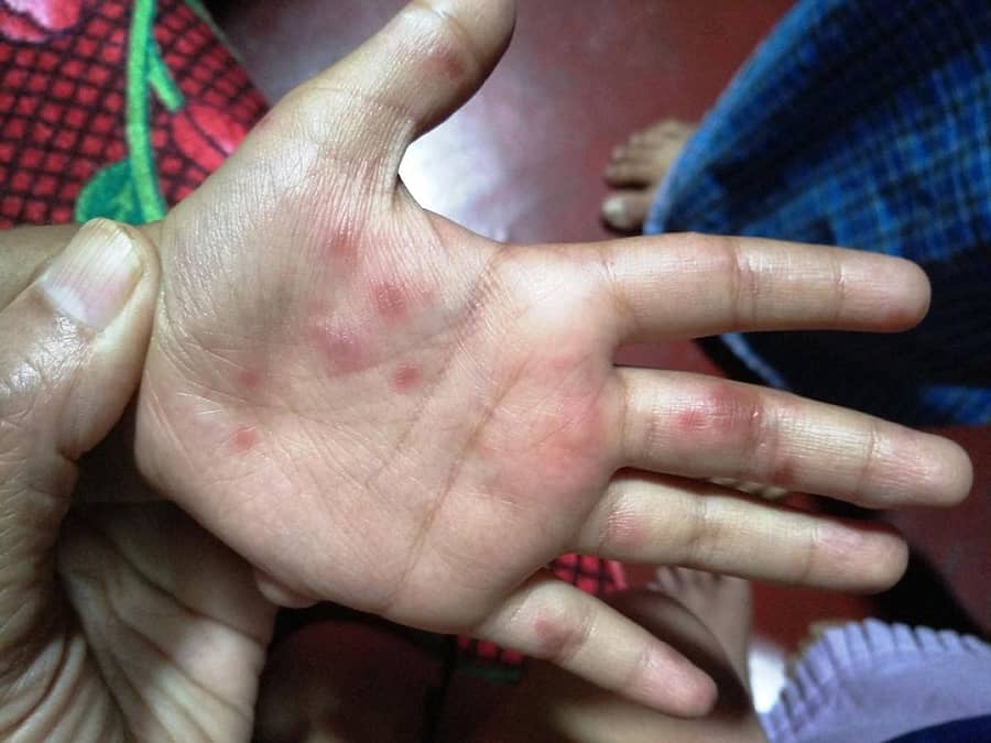 ಬಾಳೆಹೊನ್ನೂರು ಸಮೀಪದ ವೀರಗಲ್ಲುಮಕ್ಕಿ ಹಿರಿಯ ಪ್ರಾಥಮಿಕ ಶಾಲೆಯ ವಿದ್ಯಾರ್ಥಿಗಳ ಅಂಗೈಗಳಲ್ಲಿ ಕಾಣಿಸಿಕೊಂಡ ಕೆಂಪು ಗುಳ್ಳೆಗಳು.