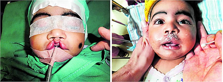 ಸೀಳು ತುಟಿ– ಶಸ್ತ್ರ ಚಿಕಿತ್ಸೆಯ ಮೊದಲು, ನಂತರದ ಚಿತ್ರ