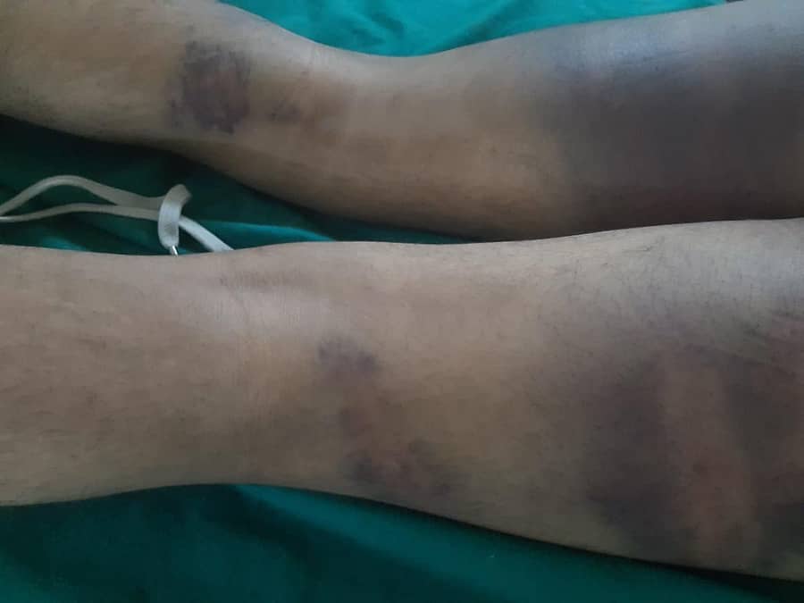 ಯುವಕನ ಮೈ ಮೇಲಿನ ಗಾಯದ ಕಲೆಗಳು