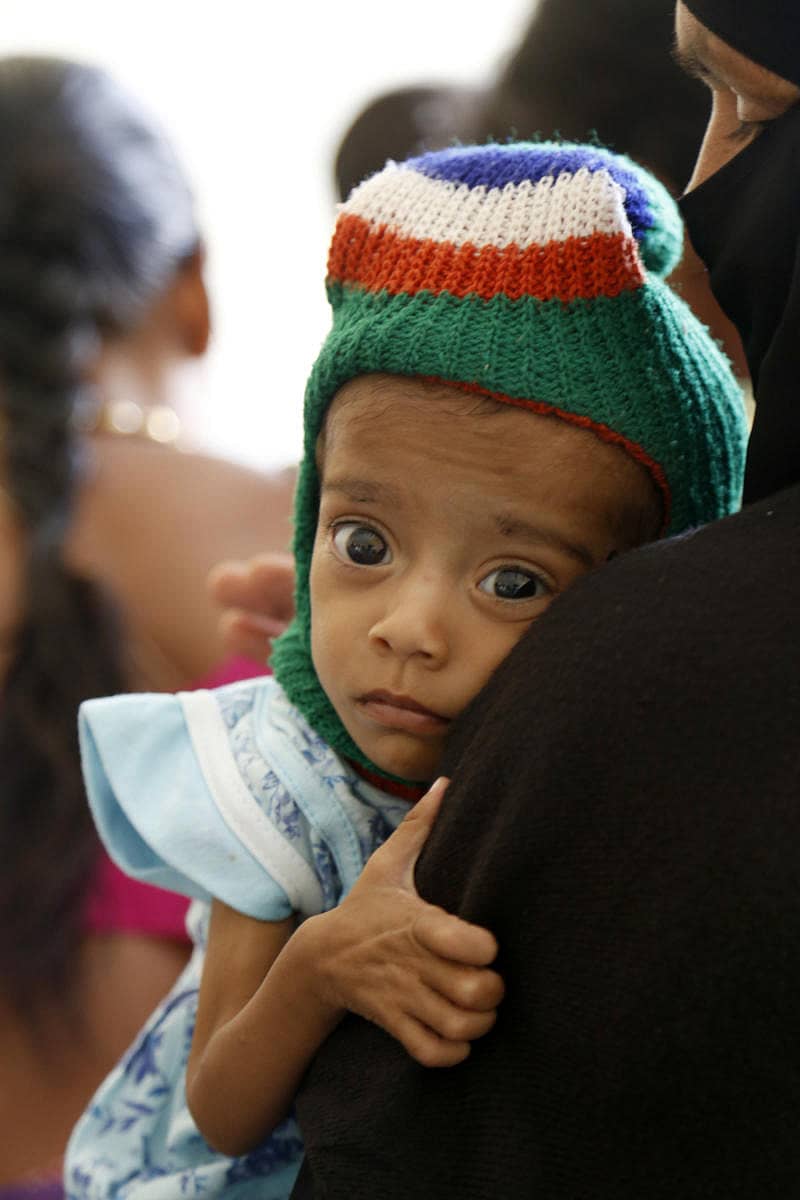 ಅಪೌಷ್ಟಿಕ ಸಮಸ್ಯೆಯಿಂದ ಬಳಲುತ್ತಿರುವ ಮಗು (ಸಾಂದರ್ಭಿಕ ಚಿತ್ರ)