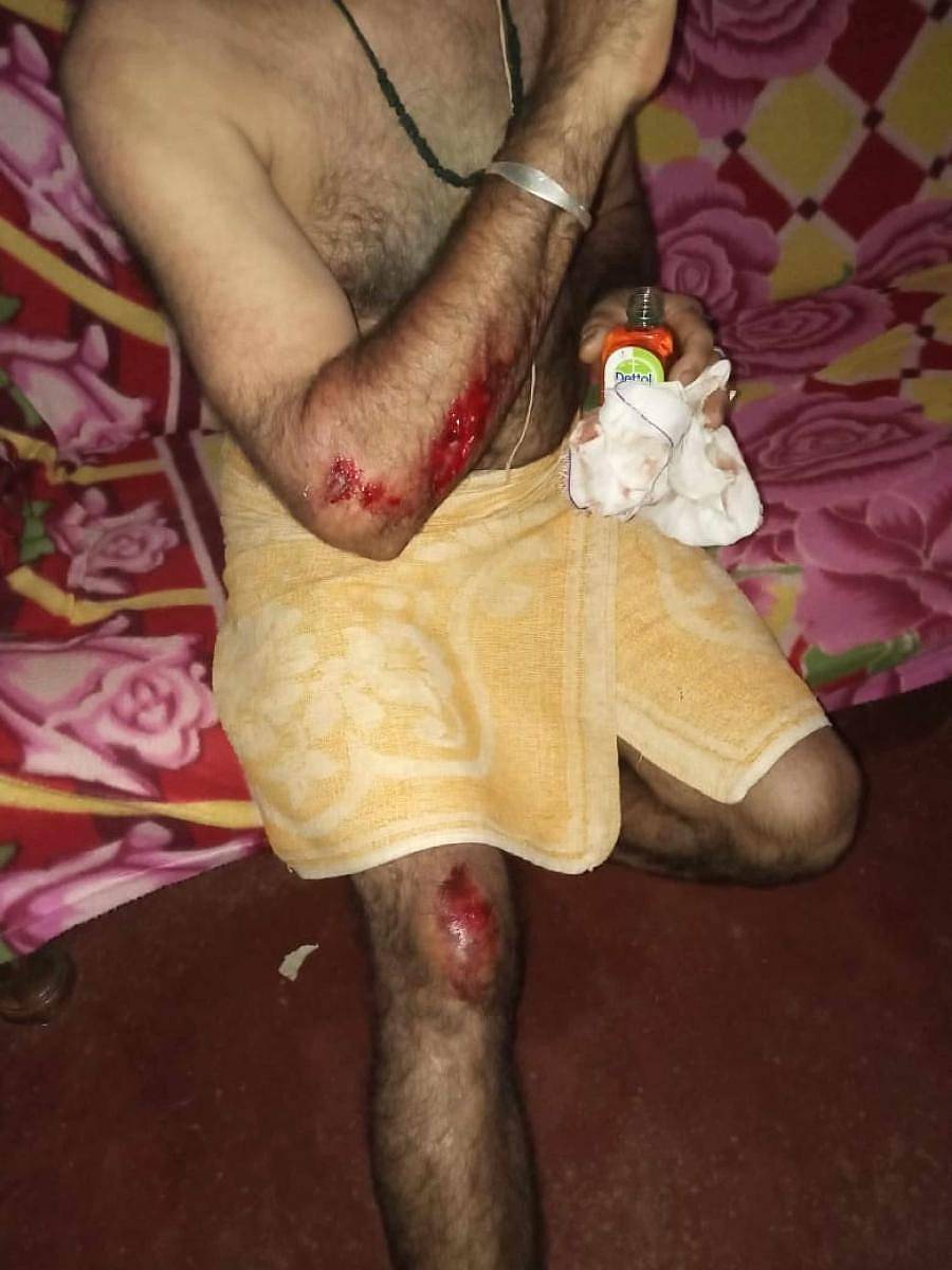 ಹಂದಿ ದಾಳಿಯಿಂದ ಗಾಯಗೊಂಡಿರುವ ಅರ್ಚಕ ರಾಮಕೃಷ್ಣ ಭಟ್ಟ