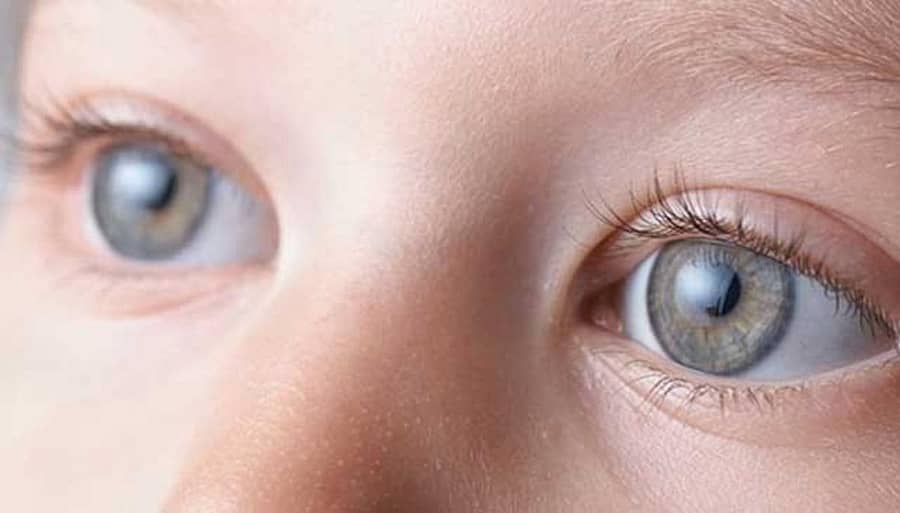 ಶಿಶುಗಳಿಗೂ ಕಣ್ಣಿನ ಪೊರೆ