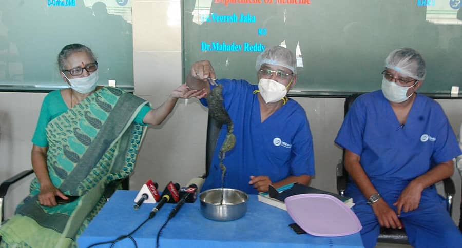 ಯಾದಗಿರಿಯ ವಿಬಿಆರ್ ಮಲ್ಟಿಸ್ಪೆಷಾಲಿಟಿ ಆಸ್ಪತ್ರೆಯಲ್ಲಿ ಶಸ್ತ್ರಚಿಕಿತ್ಸೆ ಮಾಡಿ ಹೊರ ತೆಗೆದ ಕೂದಲ ಗೆಡ್ಡೆಯನ್ನು ಪ್ರದರ್ಶಿಸಿದ ಆಸ್ಪತ್ರೆ ಮುಖ್ಯಸ್ಥ ಡಾ. ವೀರಬಸವಂತರೆಡ್ಡಿ ಮುದ್ನಾಳ ತಂಡ