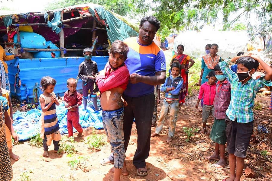 ಗುಡಿಸಲಿಗೆ ಬೆಂಕಿ ತಗುಲಿದ್ದು, ಬಾಲಕನ ದೇಹ ಸುಟ್ಟಿರುವುದು