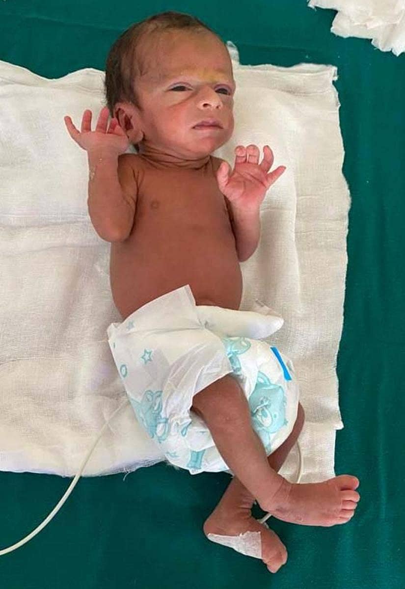 ಶಿರಸಿ ಪಂಡಿತ ಸಾರ್ವಜನಿಕ ಆಸ್ಪತ್ರೆಯಲ್ಲಿ ಚಿಕಿತ್ಸೆ ಪಡೆದ ಮಗು