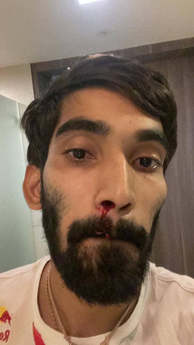 ಶ್ರೀಕಾಂತ್ ಅವರ ಮೂಗಿನಿಂದ ರಕ್ತಸ್ರಾವ–ಟ್ವಿಟರ್ ಚಿತ್ರ