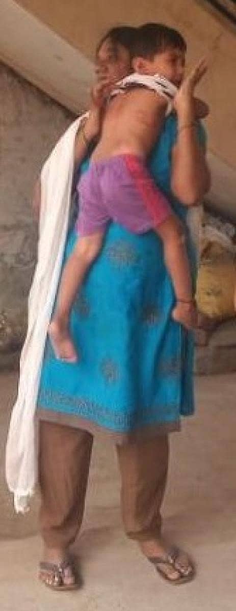 ಬೀದಿ ನಾಯಿಗಳ ದಾಳಿಯಿಂದ ರಾಜುವಿನ ಸೊಂಟ, ಹೊಟ್ಟೆಗೆ ಗಾಯಗಳಾಗಿದ್ದನ್ನು ತೋರಿಸುತ್ತಿರುವ ಅವರ ತಾಯಿ ಪೂರ್ಣಿಮಾ