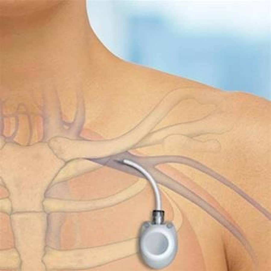 ಎದೆಭಾಗದಲ್ಲಿ ಒಳಗಡೆ ಅಳವಡಿಸುವ ಕಿಮೊ ಪೋರ್ಟ್‌ (ಪ್ರಾತಿನಿಧಿಕ ಚಿತ್ರ)