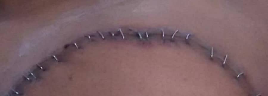 ಸರ್ಜರಿ ಸಮಯ ಹೊಲಿಗೆ ಬದಲು ಸ್ಟೆಪ್ಲರ್‌ ಪಿನ್‌ಗಳು (ಪ್ರಾತಿನಿಧಿಕ ಚಿತ್ರ)