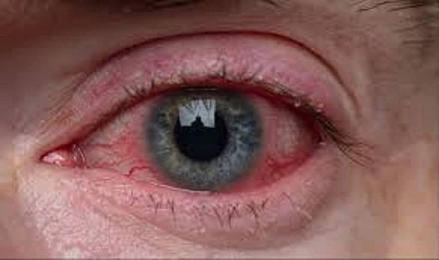 ಕಣ್ಣಿನ ಸೋಂಕು–ಪ್ರಾತಿನಿಧಿಕ ಚಿತ್ರ