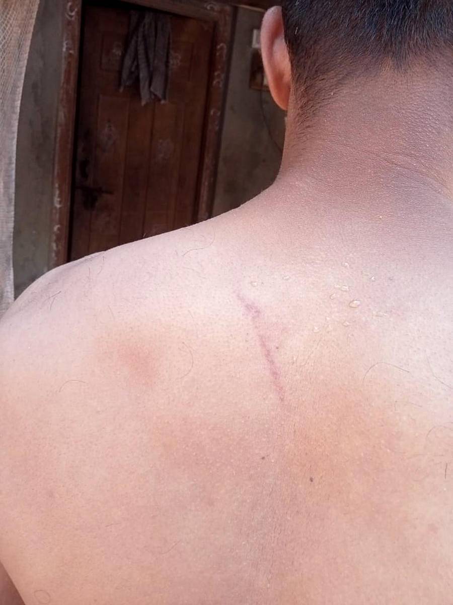 ಹೊನ್ನಾವರದ ಟೊಂಕಾದಲ್ಲಿ ಪೊಲೀಸರು ಲಾಠಿಯಿಂದ ಹೊಡೆದ ಕಾರಣ ಗಾಯವಾಗಿದೆ ಎಂದು ವ್ಯಕ್ತಿಯೊಬ್ಬರು ಹೇಳಿಕೊಂಡಿರುವ ಈ ದೃಶ್ಯ ಸಾಮಾಜಿಕ ಜಾಲತಾಣದಲ್ಲಿ ಹರಿದಾಡುತ್ತಿದೆ