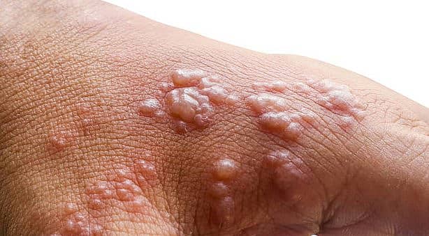 ಮಂಕಿಪಾಕ್ಸ್ 