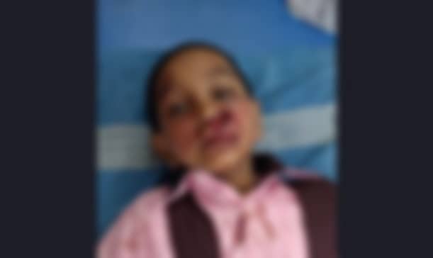 ನಾಯಿಗಳ ಕಡಿತಕ್ಕೆ ಒಳಗಾಗಿ ಆಸ್ಪತ್ರೆಯಲ್ಲಿ ಚಿಕಿತ್ಸೆ ಪಡೆಯುತ್ತಿರುವ ಬಾಲಕಿ 