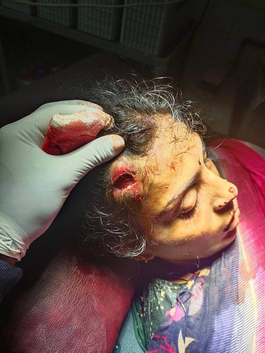 ಮಹಿಳೆಯ ತಲೆಗೆ ಗಾಯವಾಗಿರುವುದು