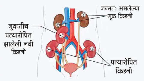 चेन्नईतील व्यक्तीवर तिसर्‍यांदा किडनी प्रत्यारोपण