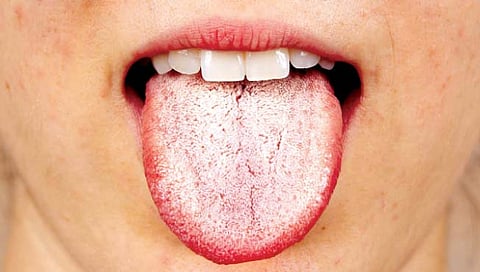 जीभ पांढरी असणे हे अनेक शारीरिक आजारांचे संकेत