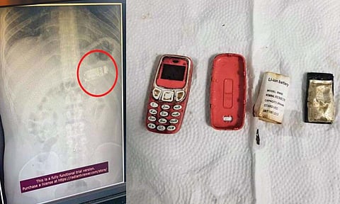 तरुणाने गिळला मोबाईल फोन!