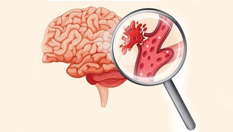 कोरोनाच्या तिसर्‍या लाटेत ‘ब्रेन स्ट्रोक’चा मोठा धोका, तुटताहेत मेंदूतल्या नसा!