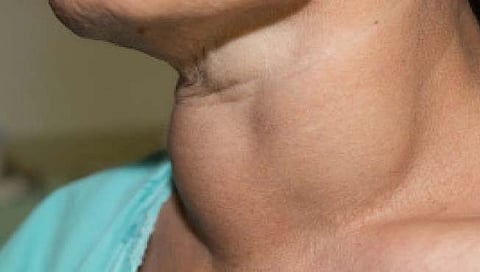 गलगंड आजार कशामुळे होतो? त्यावर हे आहेत उपचार