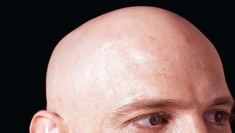 पुरुषांनाच का पडते टक्‍कल? जाणून घ्या कारण