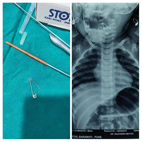एक्स - रे मध्ये घशात अडकलेली सेफ्टी पिन दिसत असून उजवीकडे बाहेर काढलेली पिन