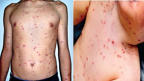 कांजिण्याची समस्या