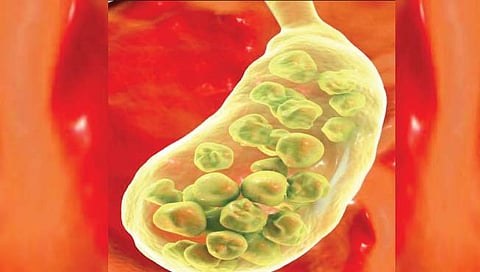 पित्ताशयाचे खडे आणि होमिओपॅथिक उपचार