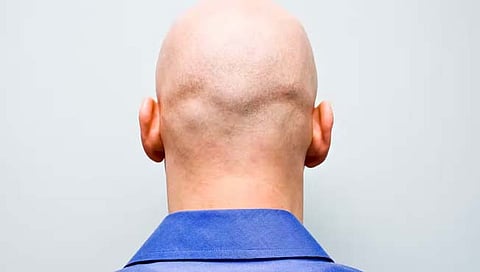 Bald : ऑफीसमध्‍ये कर्मचार्‍याला ‘टकल्‍या’ म्‍हणणे हे लैंगिक अत्‍याचारासारखेच! : ‘या’ देशाच्‍या कोर्टाचा निकाल