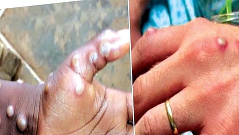 मंकीपॉक्सचा धोका किती?