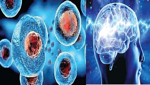 अल्झायमरवर स्टेम सेल थेरपी?