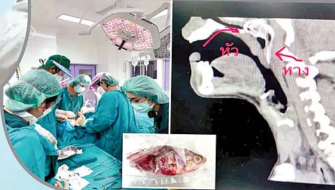 गळ सोडून गळ्यात घुसला मासा!