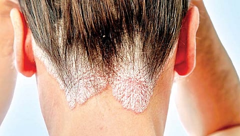 ओळखा सोरायसिसची लक्षणे