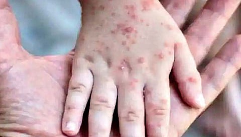 गोवा : बालकांना छोट्या फोडांचा आजार