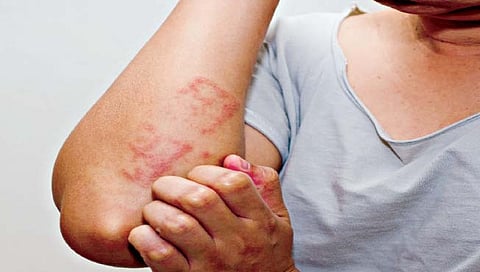 अ‍ॅलर्जी कशामुळे होते? यावर ‘हे’ आहेत उपाय
