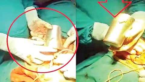 पोटातून काढला स्टीलचा मोठा ग्लास