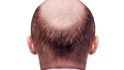 डोक्यावर पुन्हा केस उगवू शकणार्‍या प्रोटिनचा शोध