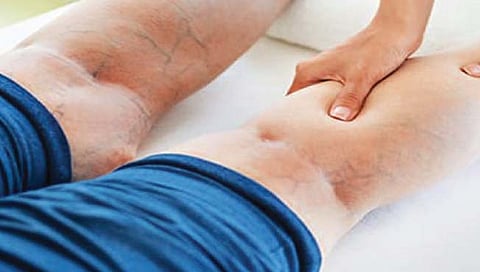 समस्या सीव्हीआयची