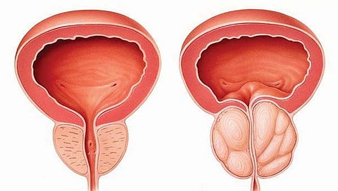Prostate problems : आयुर्वेद उपचार, आहार आणि पथ्‍य जाणून घ्‍या सविस्‍तर