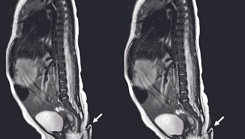 सहा इंचांच्या शेपटीसह मुलीचा जन्म!