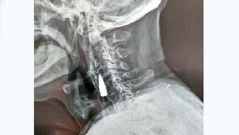 तब्बल 77 वर्षांपासून मानेत बंदुकीची गोळी!