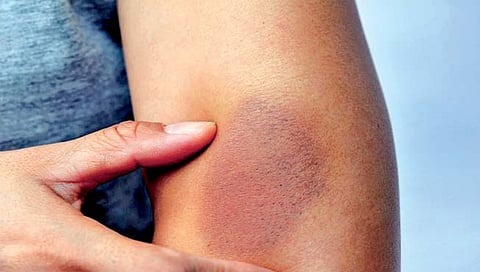 त्वचेवर काळे-निळे डाग पडण्याची ‘ही’ आहेत कारणे? जाणून घ्या उपाय