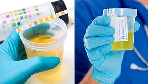 युरीनचा रंगबदल आणि आरोग्य