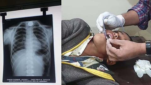 गिळले ५ रुपयांचे नाणे 