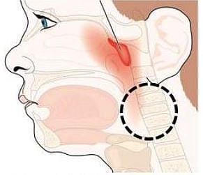 अडेनॉईड आणि होमिओपॅथिक उपचार