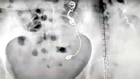 ‘तिच्या’ पोटात होता चक्क सुई-धागा!